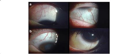 Anterior Segment Photograph Of Sectoral Scleritis Before A And After B