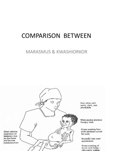 Comparison Between Marasmus And Kwashiorkorpdf
