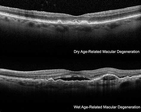 Macular Hole Surgery Vitreous Retina Macula Consultants Of New York