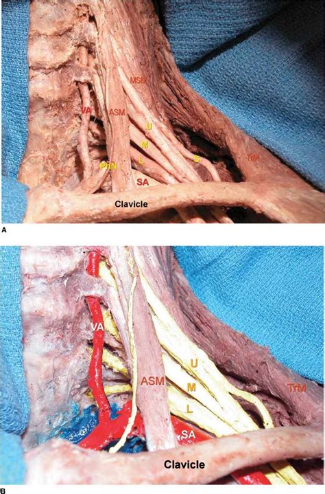 Supraclavicular Brachial Plexus Block Hadzics Peripheral Nerve