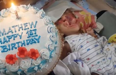 Baby Born Without Face Defies All Odds To Celebrate His First Birthday Best World News