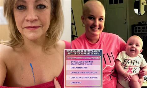 The Breast Cancers That Don T Start With A Lump Two Survivors Of Rarer