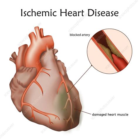 Ischemic Heart Disease Illustration Stock Image F022 1734 Science Photo Library