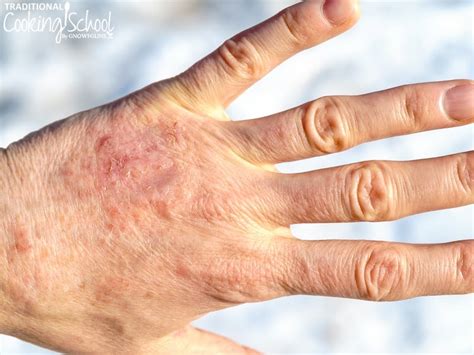 16 Tips To Prevent And Heal Dry Winter Skin Naturally