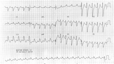 The Ecg In Pulmonary Embolism Life In The Fas