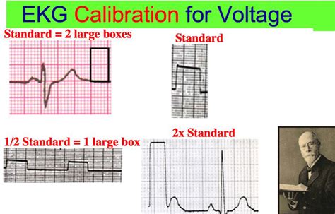 May count peaked t waves as qrs complexes or miss qrs complexes with reduced amplitude. Calibration