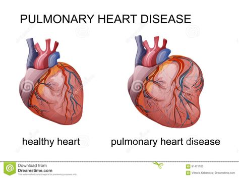 Pin By Anja Simonović On Pathology In 2021 Pulmonary Heart Disease