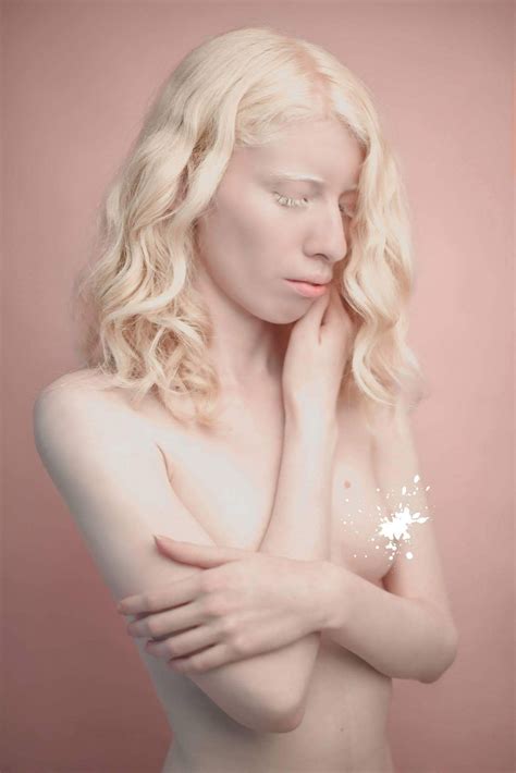 Albino Model Says Being Different Is A Blessing