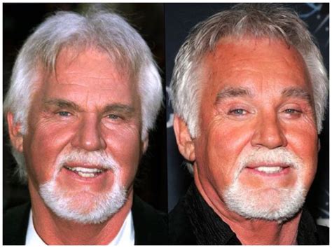 Kenny Rogers Face Lift Before And After Photos ~ Celebrity Plastic Surgery News Before And
