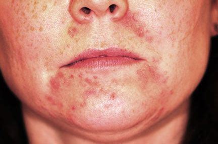 Facial Rash Caused By Yeast Infection Nude Gallery Comments