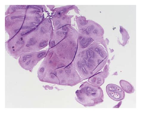 Squamous Cell Papilloma Of The Esophagus A Case Series Highlighting