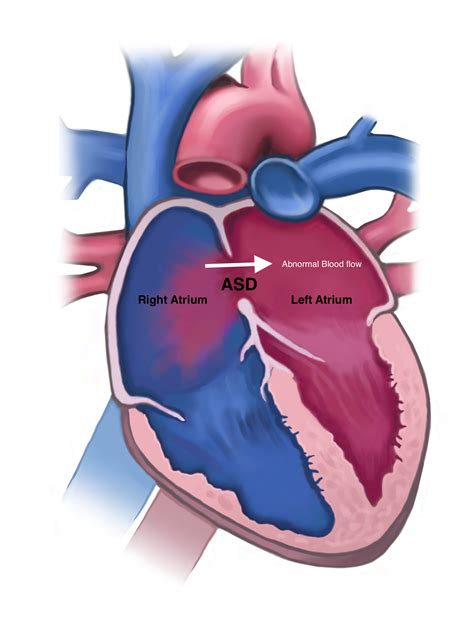 Atrial Septal Defect The Keyhole Heart Clinic