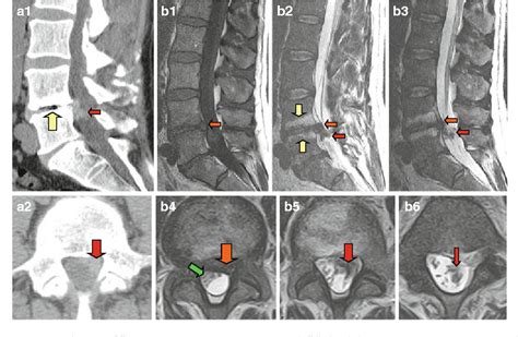 Chronic Dura Erosion And Intradural Lumbar Disc Herniation Ct And Mr