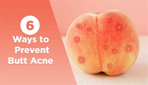 6 Ways To Prevent Butt Acne Htv