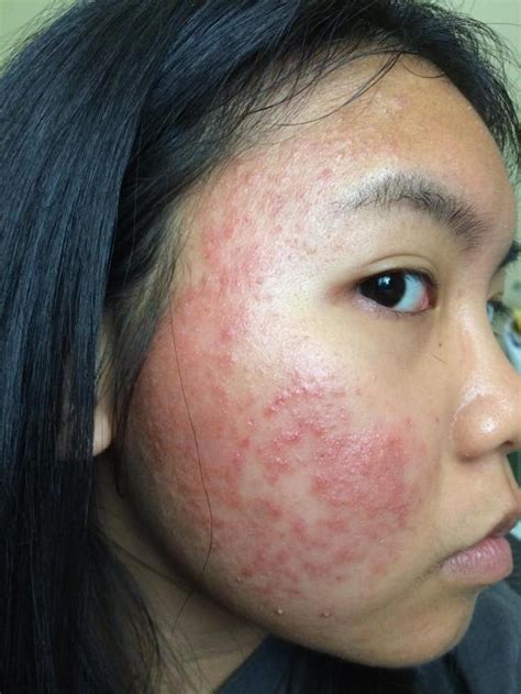 Allergic Reaction Rash On Face