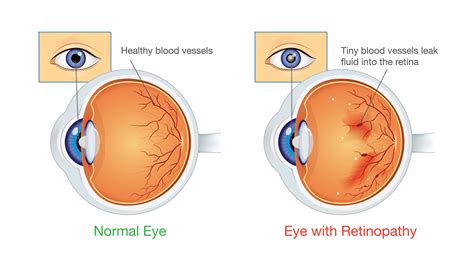 What Is Diabetic Retinopathy The Lighthouse For The Blind Inc