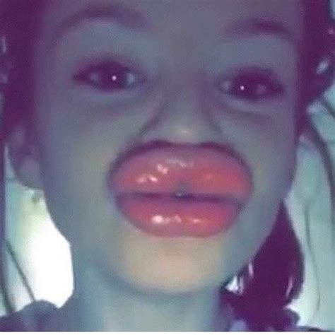20 Reasons Why You Shouldnt Try The Kylie Jenner Lip Challenge