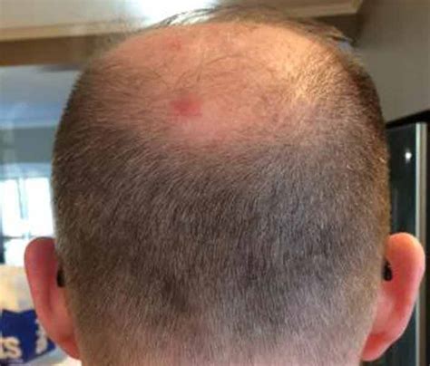 Bed Bugs In Hair Symptoms Pictures And Get Rid Pestbugs