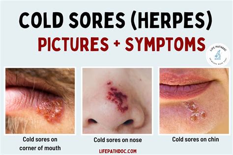 Cold Sores Pictures Of What They Look Like And Symptoms