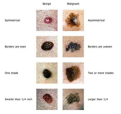Pictures Of Skin Cancer Md