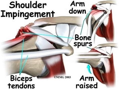 Shoulder exercises are great for shoulder tendonitis pain relief. Shoulder Impingement: Signs and symptoms - YouTube