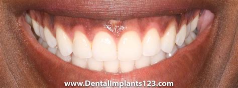 Dark Gums Can They Be Changed Dental Implants Chrysalis Dental