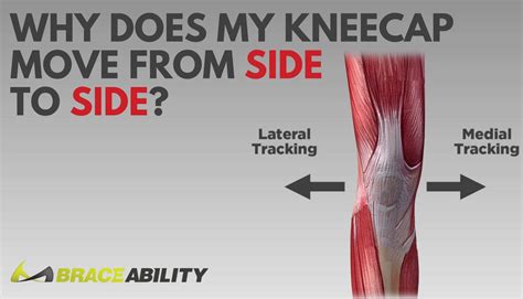 Kneecap Instability Medial Vs Lateral Patellar Dislocation