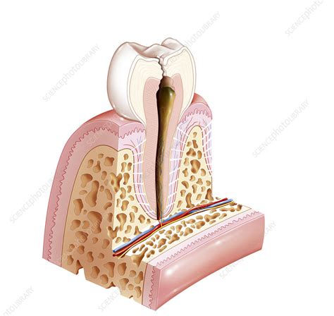 tooth decay stock image  science photo library