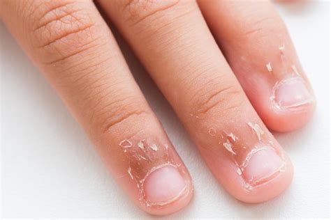 Premium Photo Close Up Childs Fingers With Dry Skin Eczema Dermatitis