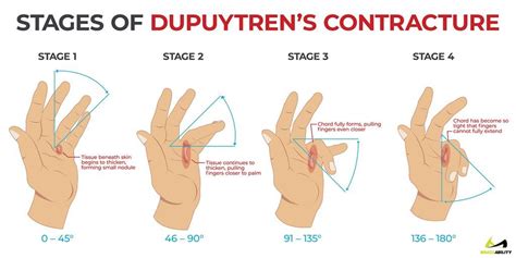 All You Need To Know About Dupuytrens Contracture Dupuytrens Contracture Trigger Finger