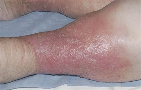 Figure 2 From Chronic Peripheral Oedema The Critical Role Of The