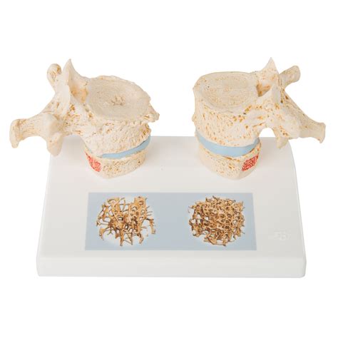 Osteoporosis Model A95 Anatomical Parts And Charts