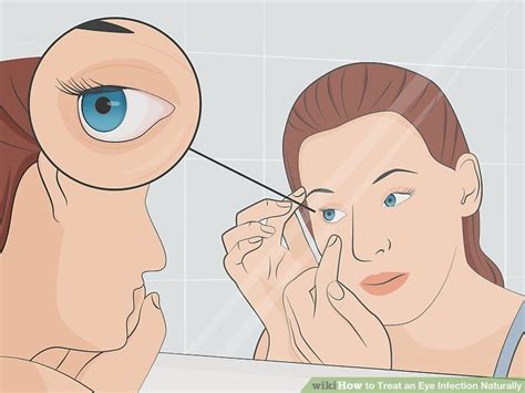 5 Ways To Treat An Eye Infection Naturally Wikihow