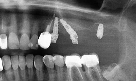 Sinus Lift Procedure Ratoath Dental And Implant Centre