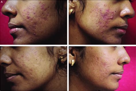 Erythematous Acne Scars Grade 3 With Few Active Acne Lesions A And