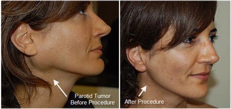 Removal Parotid Tumor Parotid Tumor Surgery Salivary Gland Surgery