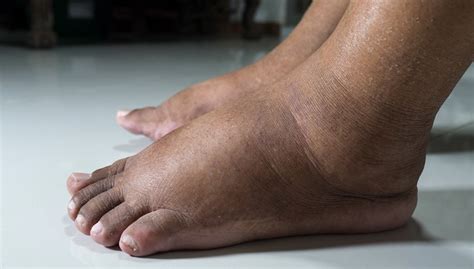 Diabetes Swollen Feet Causes 6 Powerful Ways To Manage It Every