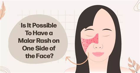 Is It Possible To Have A Malar Rash On One Side Of The Face Mylupusteam