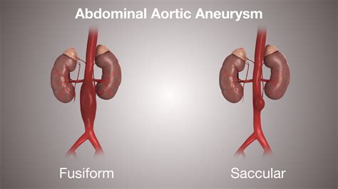 Aortic Aneurysm Causes Cation