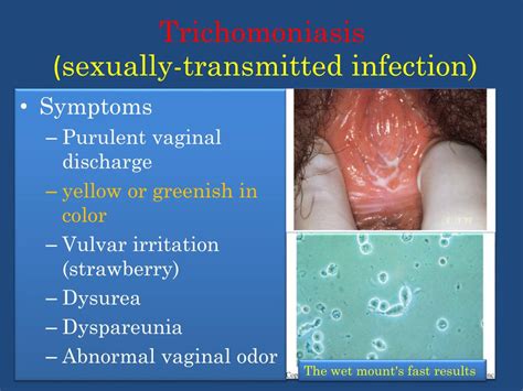 Trichomonas Vaginalis Discharge