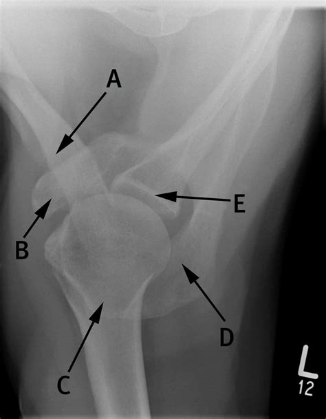 Axial View Radiograph Of The Shoulder The Bmj