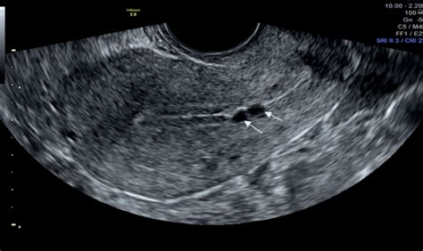 Chapter 4 Sonographic Assessment Of Uterine Fibroids And Adenomyosis