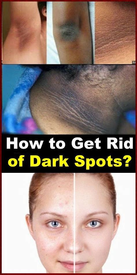 How to fade dark marks on black skin buttocks? How to Get Rid of Dark Spots? - Page 6 of 6 (With images ...