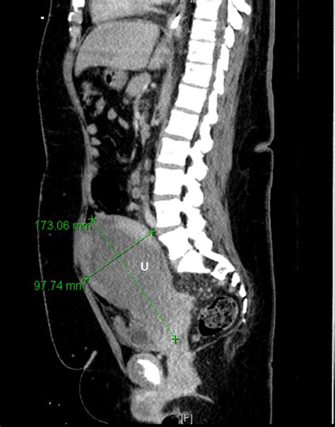 Sagittal View Of Ct Abdomen And Pelvis With Intravenous Contrast