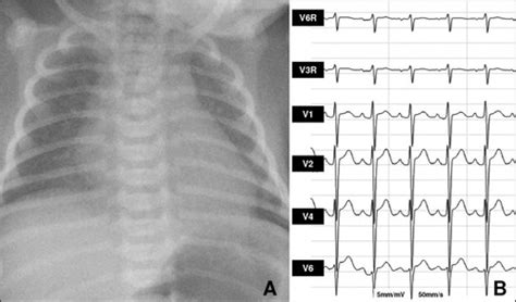 Hypoplastic Left Heart Syndrome With Left Ventricular Myocardial