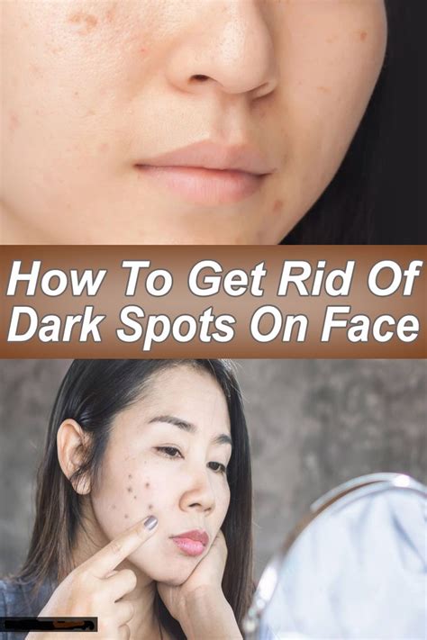 How To Get Rid Of Dark Spots On Face Dark Spots On Face Spots On