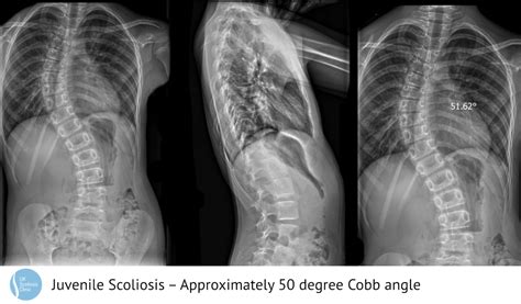 Scoliosis Awareness Month Early Onset Scoliosis Scoliosis Clinic Uk