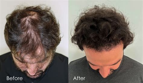 Hairline Restoration With 2950 Grafts Alvi Armani Hair Transplant Los Angeles