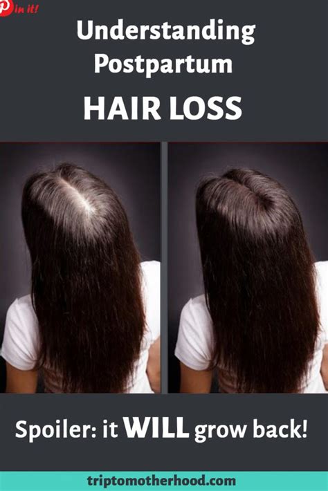 Postpartum Hair Loss The Truth Best Treatments To Make It Stop
