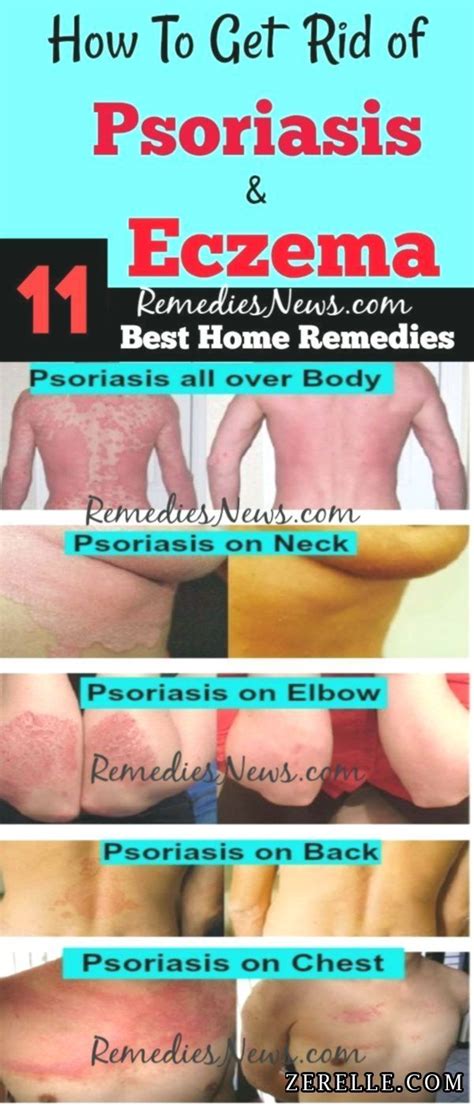 11 Greatest Residence Cures To Get Rid Of Psoriasis Completely In 2020